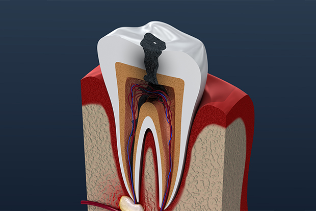 重度のむし歯は根管治療を行います